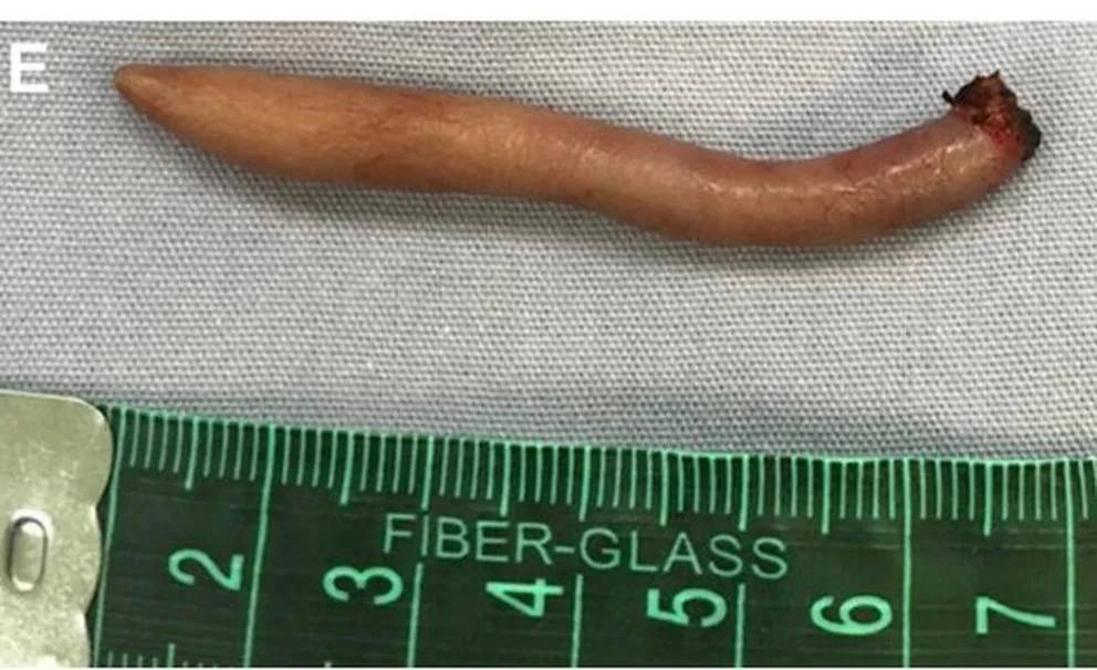 Médicos cortan cola de niña recién nacida