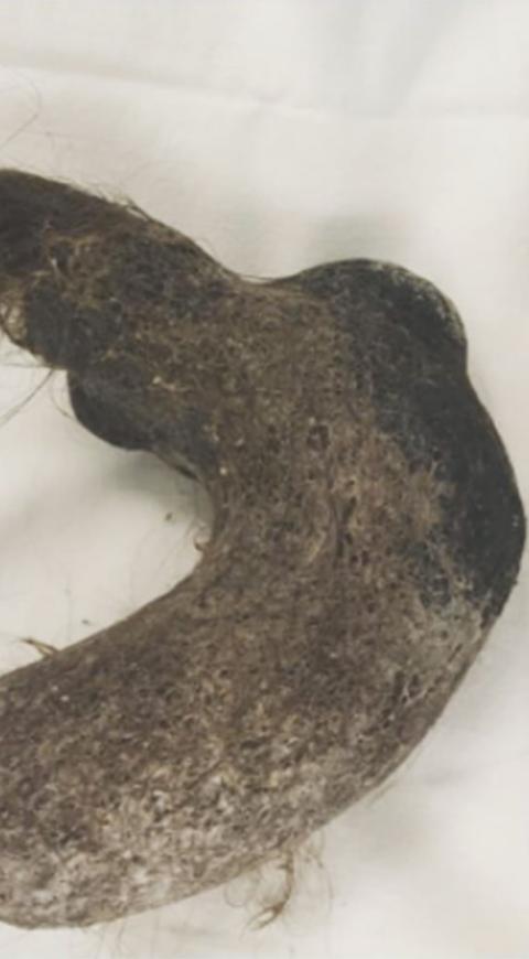 La bola de pelos hallada en estómago de una niña