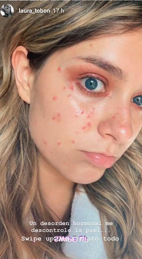 Rostro de Laura Tobón con acné