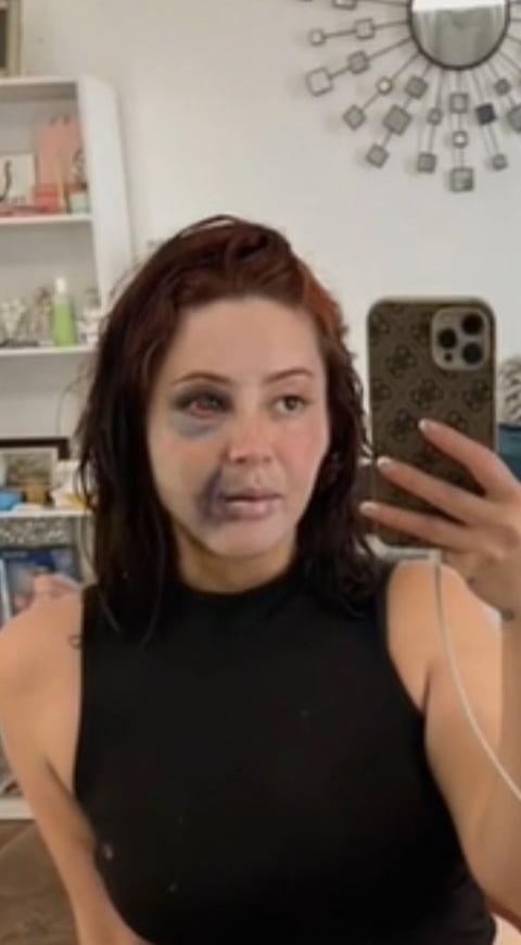 joven afectada por una bichectomia joven afectada por una bichectomia, con la cara morada e inflamada