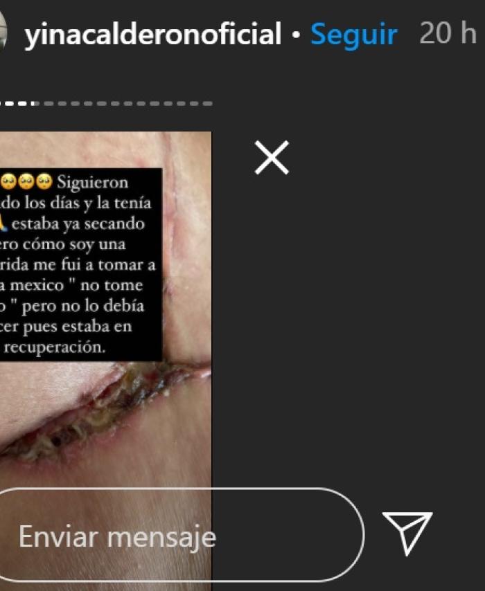 Cirugía a Yina Calderón