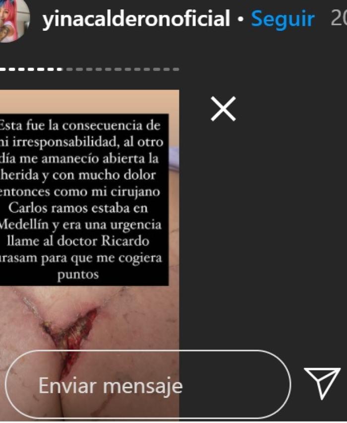 Cirugía a Yina Calderón