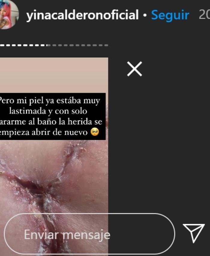 Cirugía a Yina Calderón