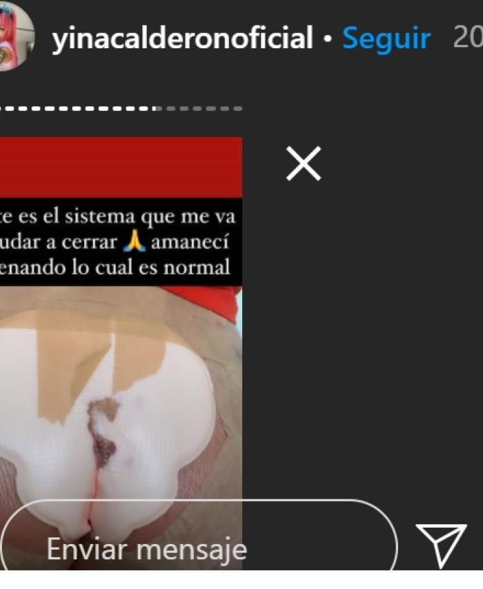 Cirugía a Yina Calderón